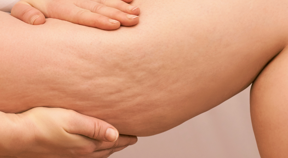 lipedema