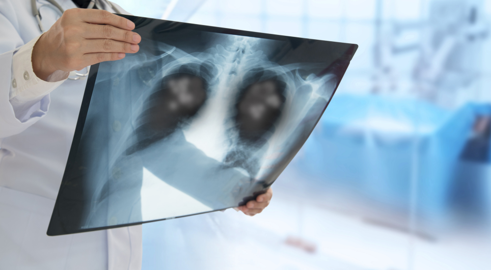 pneumonia