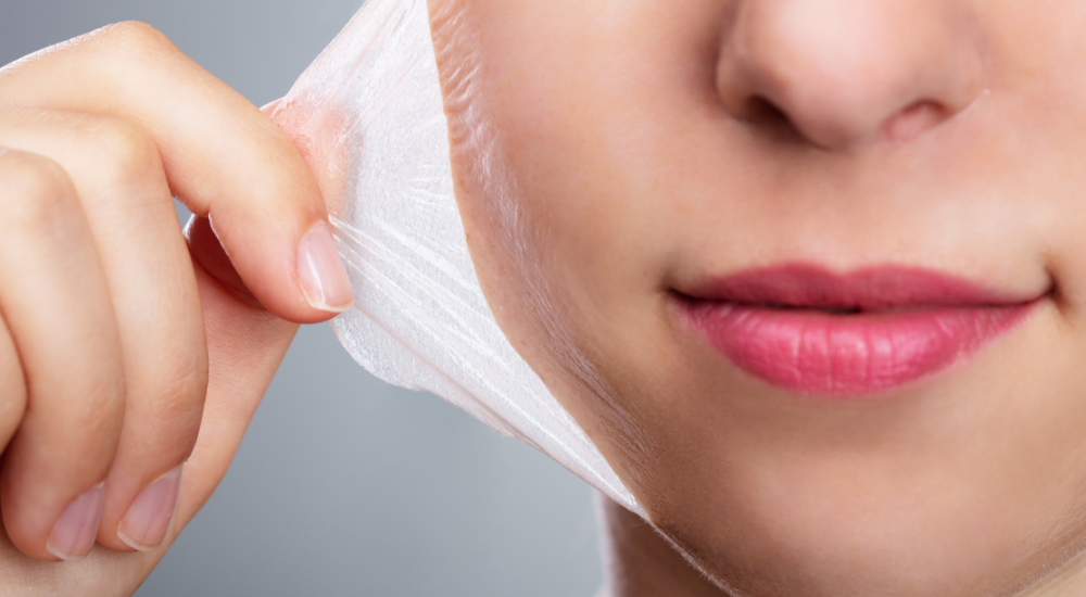 peeling de fenol