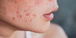 Acne: 7 maneiras de tratar esse problema
