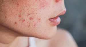 Acne: 7 maneiras de tratar esse problema