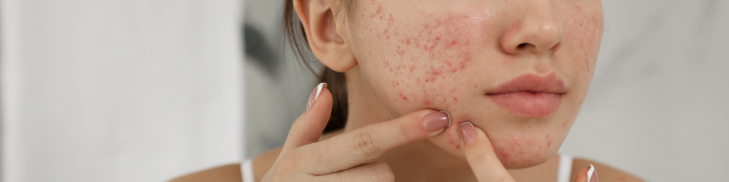 O que é a acne?