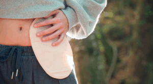 Estoma: cuidado, adaptação e qualidade de vida