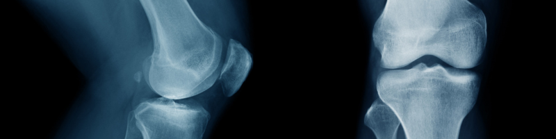 Como funciona o tratamento da condromalácia patelar?