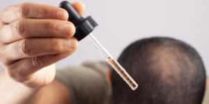 Minoxidil realmente funciona? Entenda os resultados e cuidados!