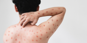 Mpox no Brasil: situação atual e cuidados importantes