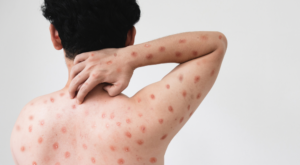 Mpox no Brasil: situação atual e cuidados importantes