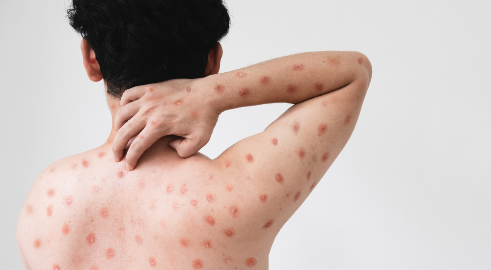 Mpox no Brasil: situação atual e cuidados importantes