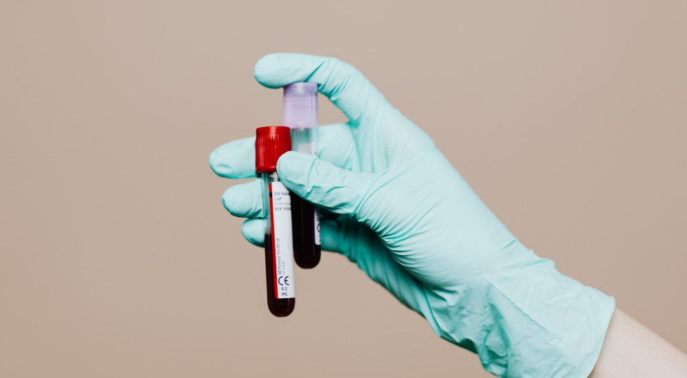 Lítio no sangue: por que esse exame é importante